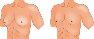 Gynaecomastia Treatment: Ask Your Doctor These 7 Questions