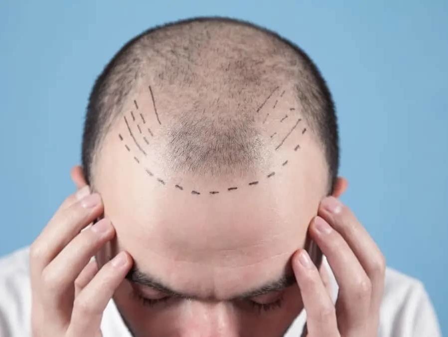 Is Hair Transplant a Painful Procedure?