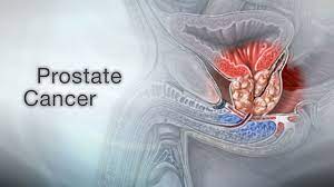 Prostate-specific antigen (PSA)