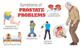 Prostate-specific antigen (PSA)