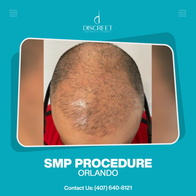 4 Tips to Choose the Right Scalp Micropigmentation Artist