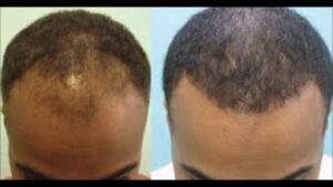 hair transplant for african american